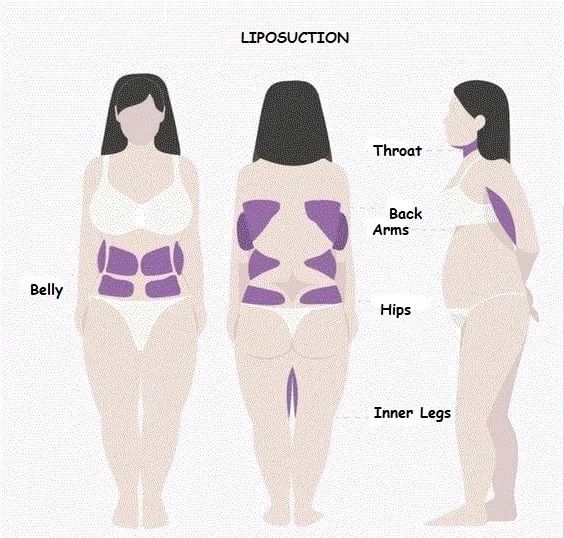 Areas of Liposuction 