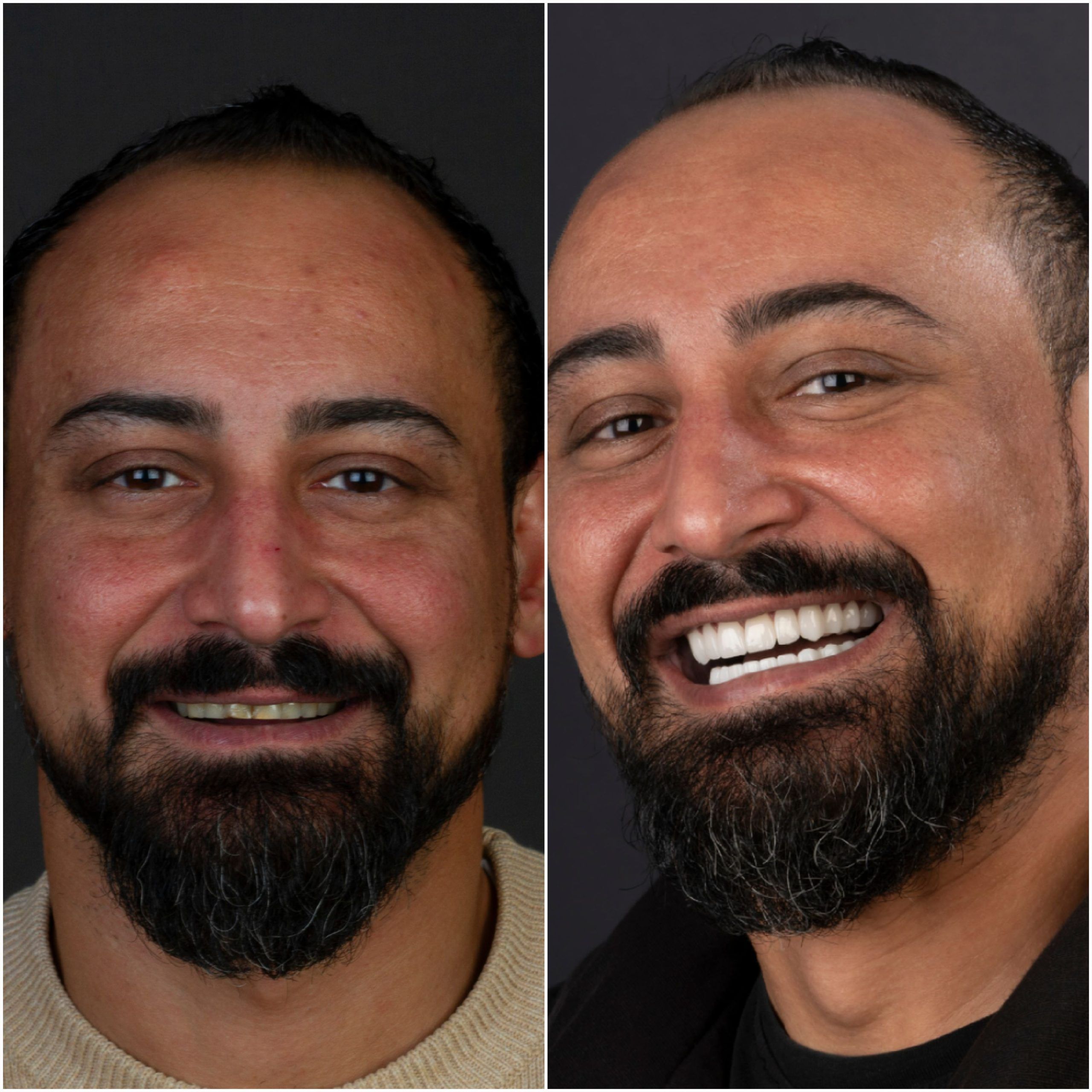 Before and After Smiling Young Man Happy with his Smile design results White teeth Dental Veneers