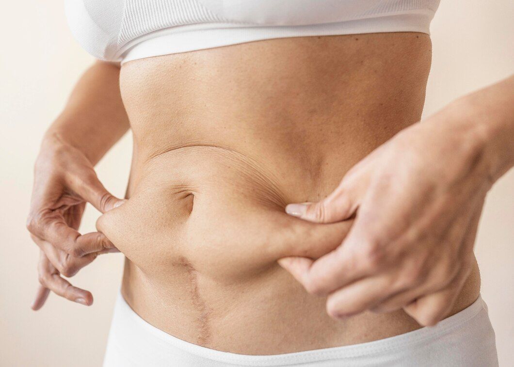 A woman holding her tummy before the abdominoplasty surgery