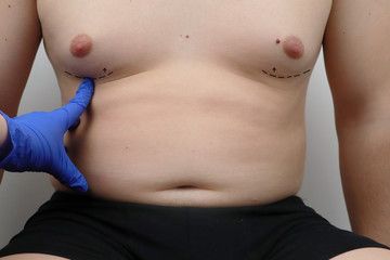 Male breasts liposuction