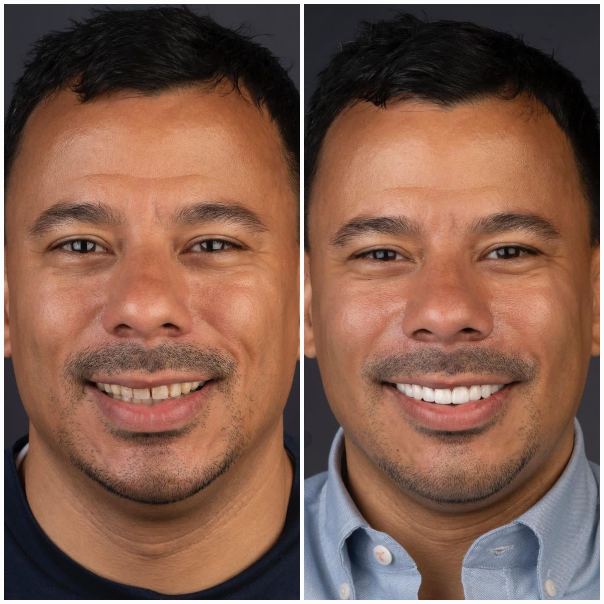 Young Man Smiling, before and after White teeth Dental Veneers Smile Design