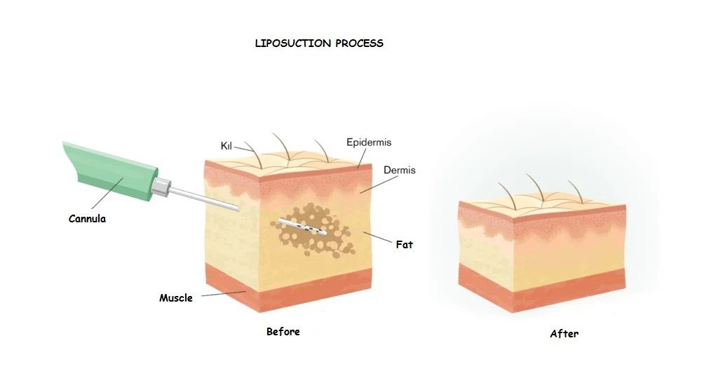 Before After Liposuction