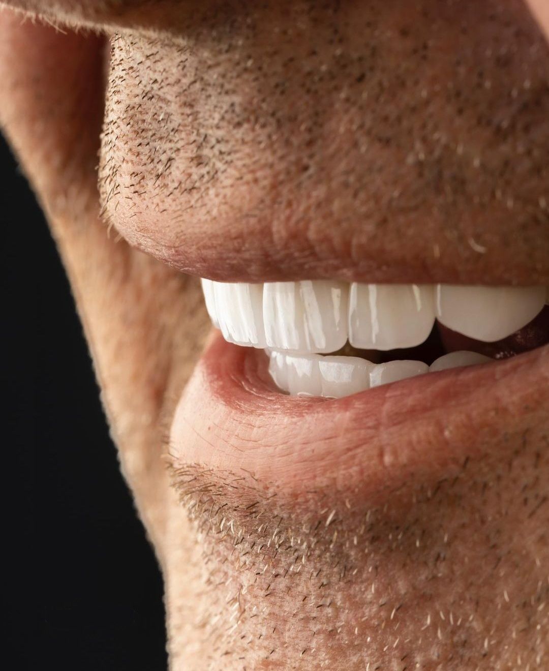 Teeth of a middle aged man. Dental veneers. White teeth