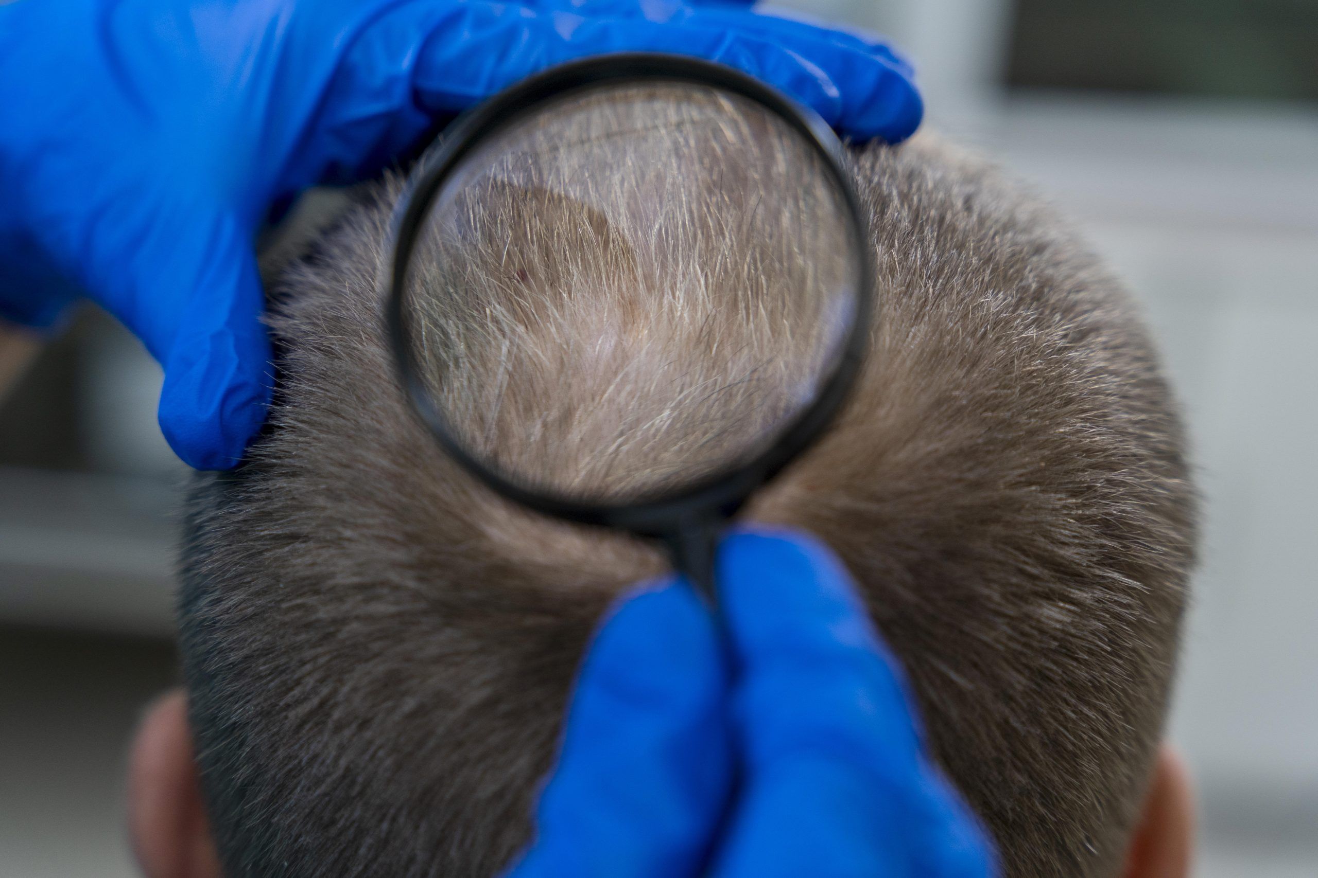 Hair Transplant Specialist Inspecting Hair of A Man