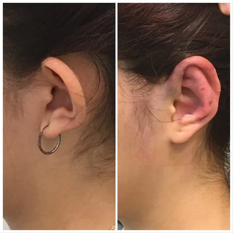 A Woman with Otoplasty Before and After