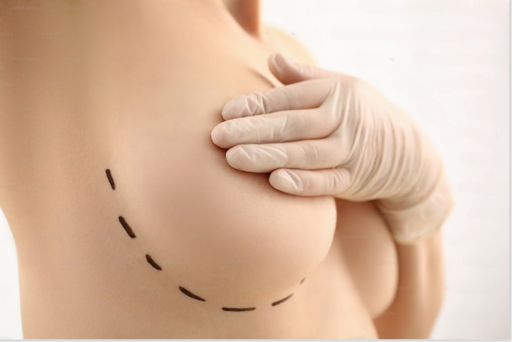 Breast Reconstruction