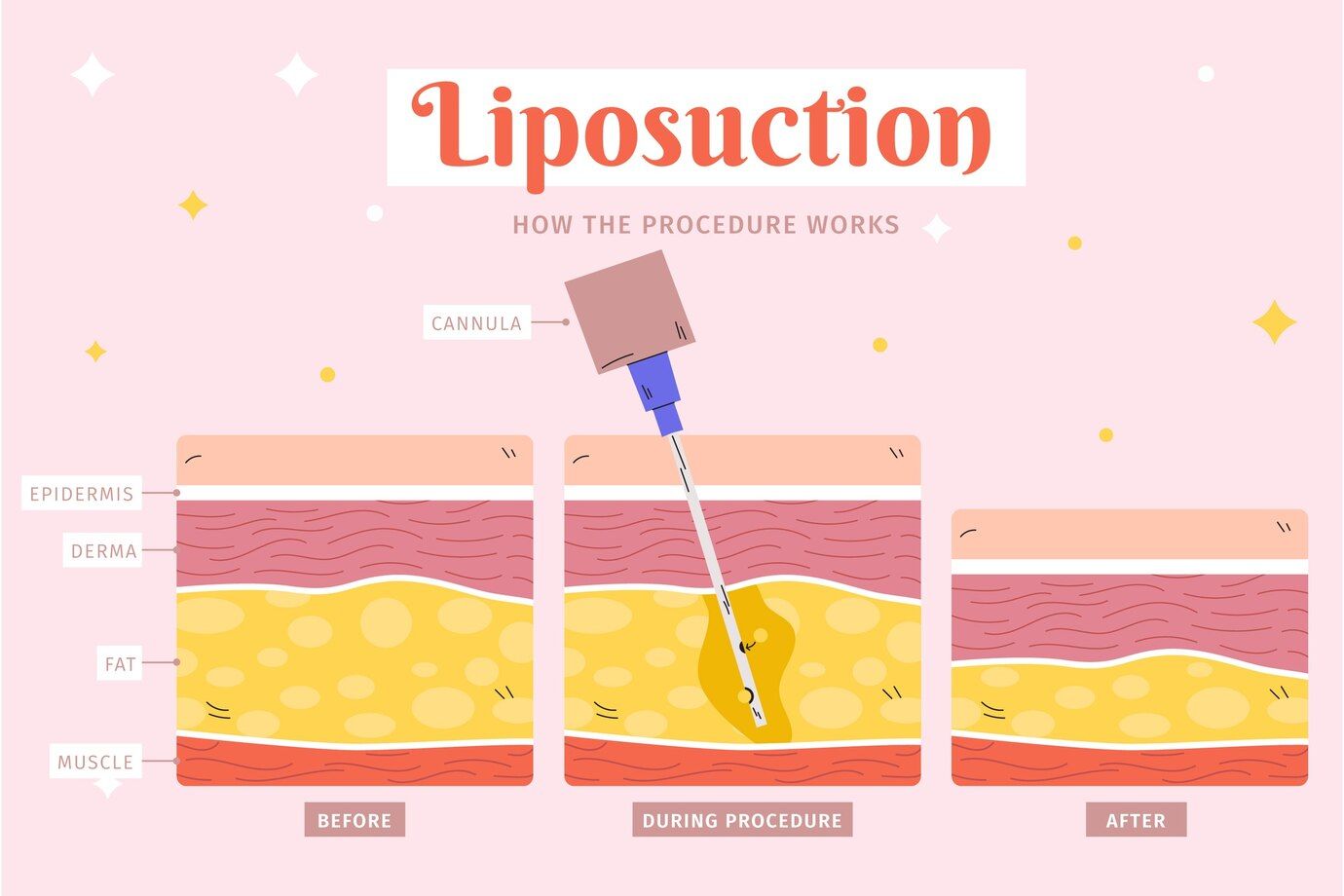 Liposuction how the procedure works