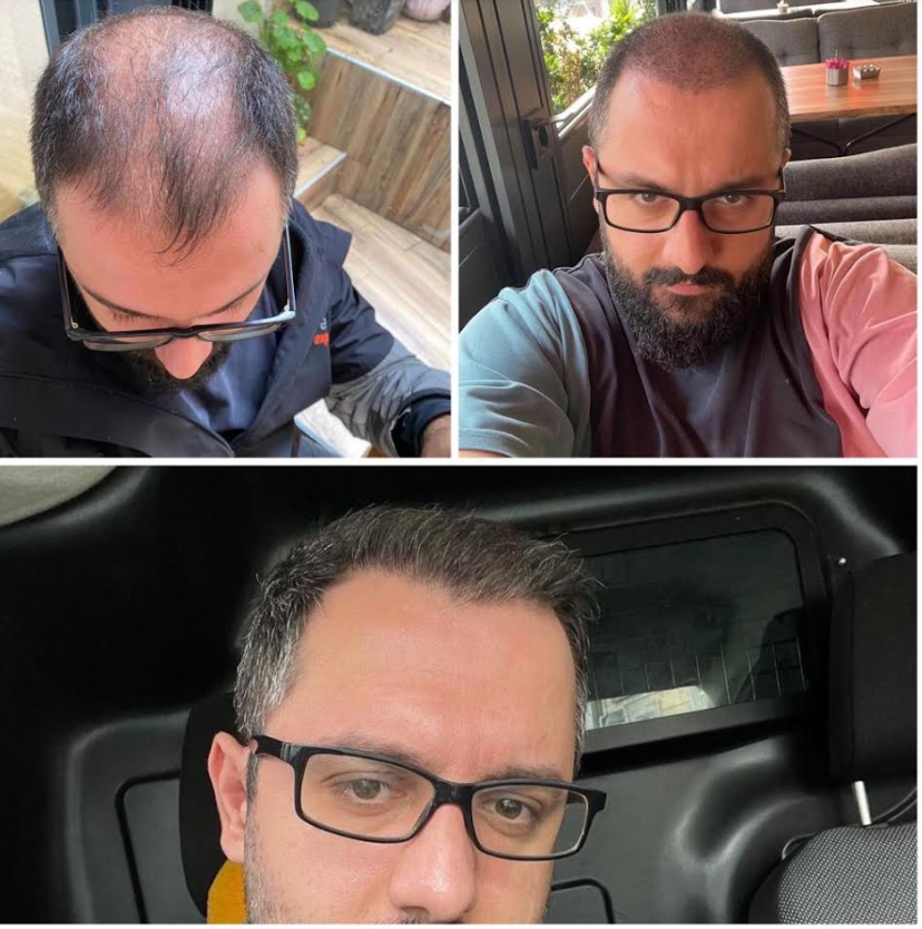 Before and after hair transplant pictures