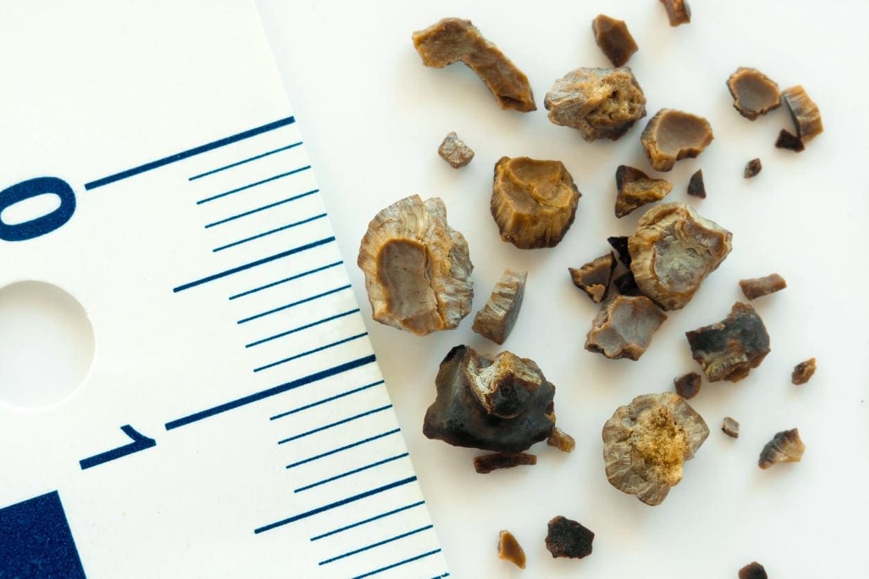 Kidney Stone