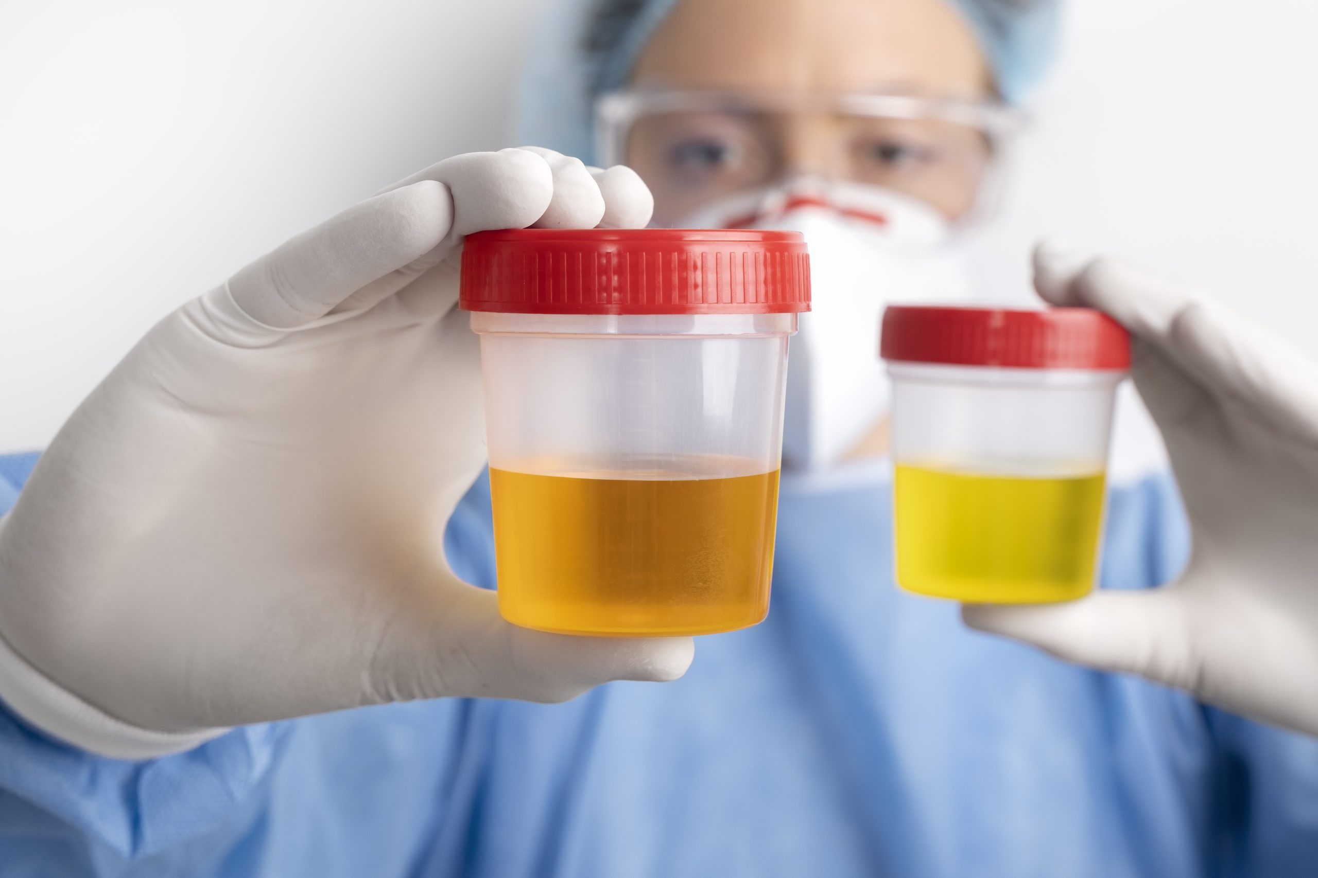 Urologist examining pee sample with blood and normal sample