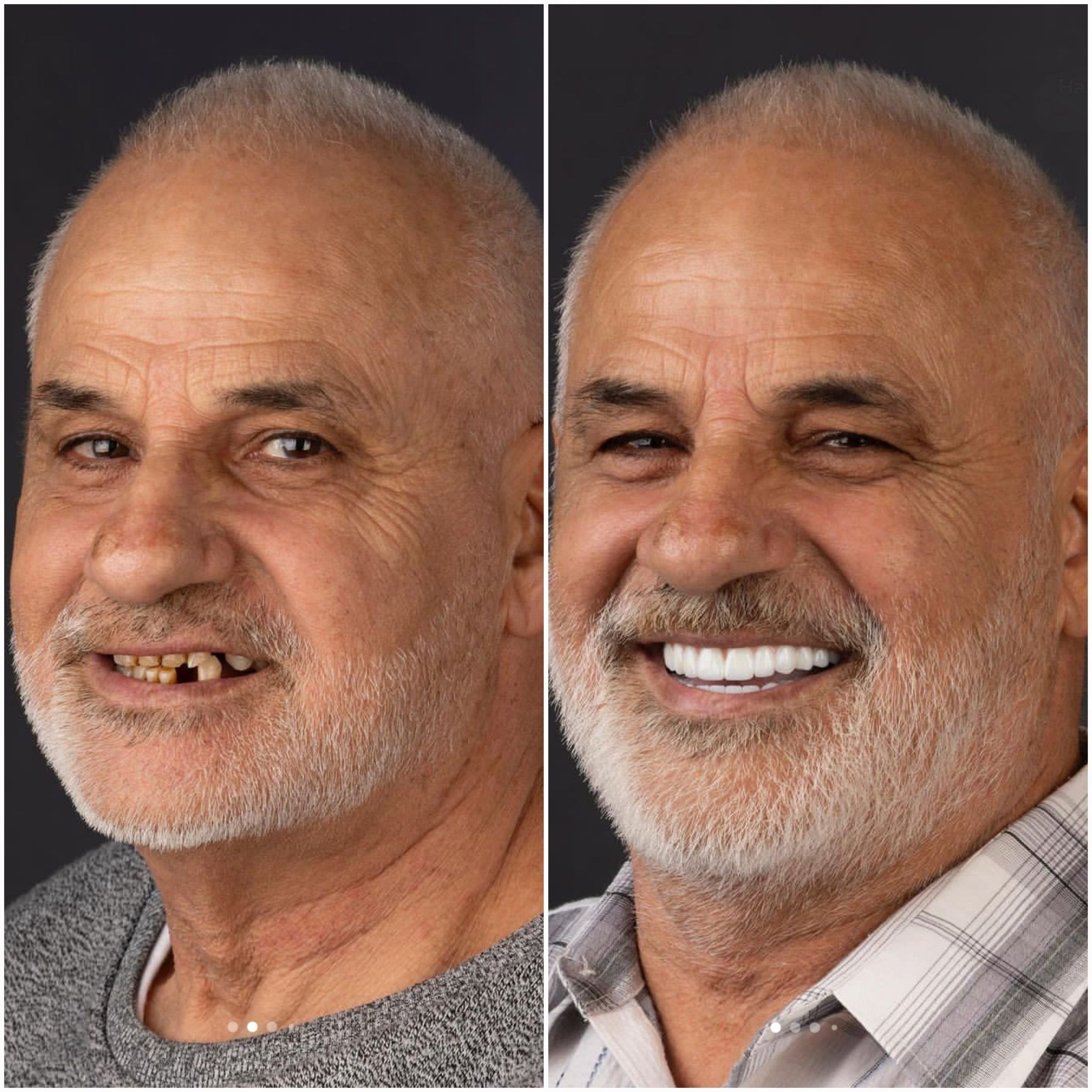 Smiling Old Man White teeth Dental Implants Good results