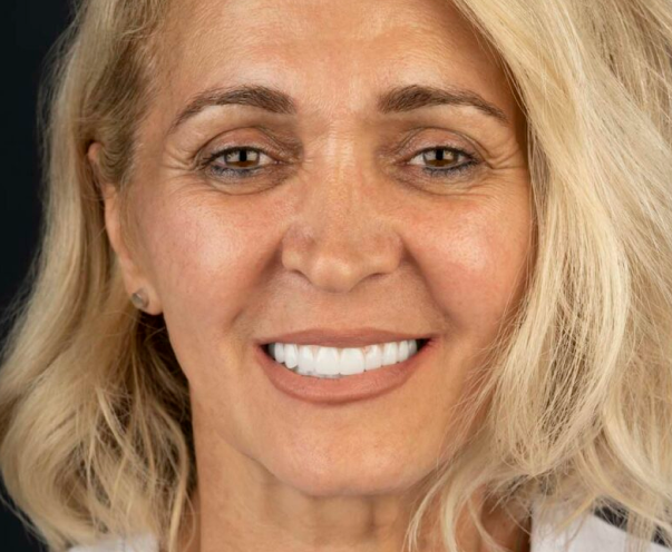 Old woman getting dental veneers and has white teeth